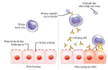 Hiện tượng tự miễn ở người do vi khuẩn lậu