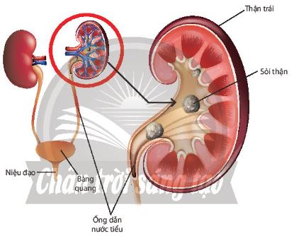 Sỏi thận và đường tiết niệu