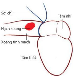 Buộc chỉ ngăn cách xoang tĩnh mạch với tim